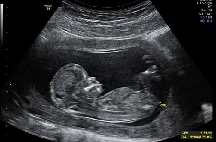 ecografia-1-1-1-e1571913047457